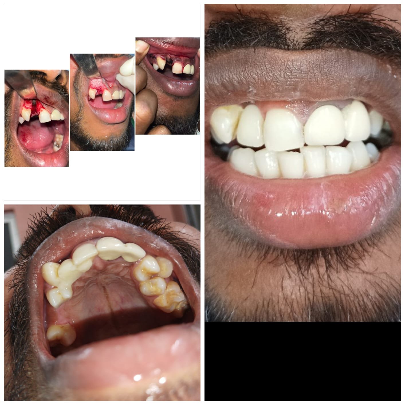 Dental implant placement